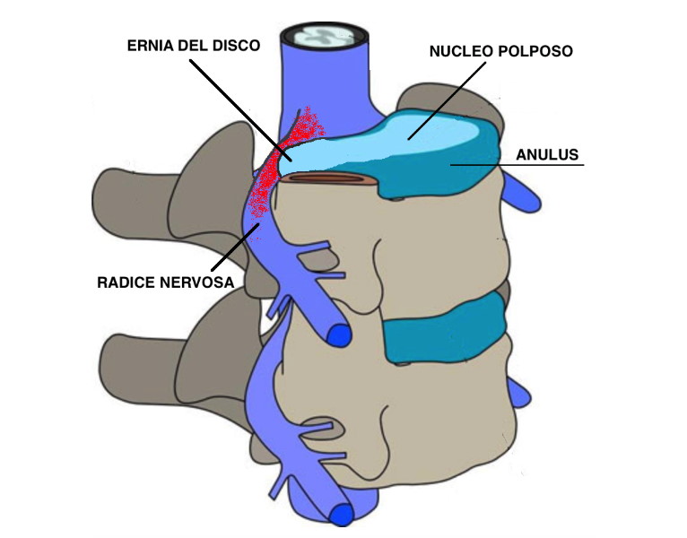 vertebra-con-ernia-del-disco
